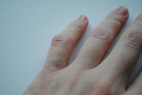 An arthritis lump appeared on the little finger. 