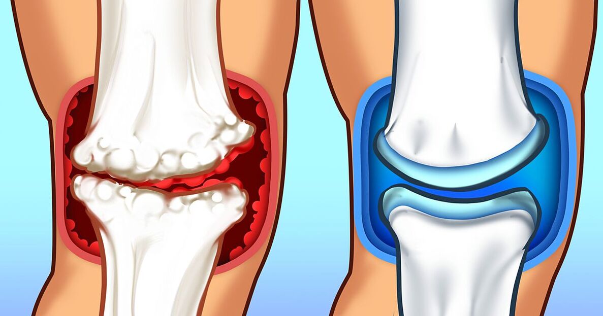 Hondrox restores cartilage tissue and the layer between them