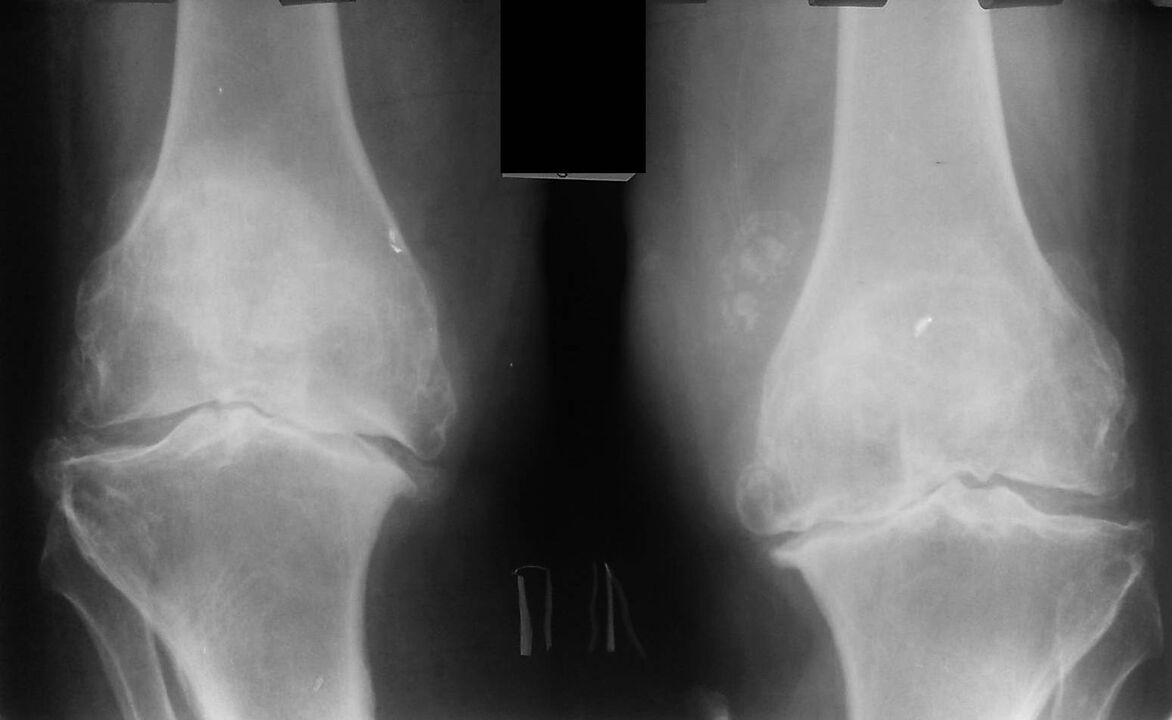 x-ray of knee joints with osteoarthritis