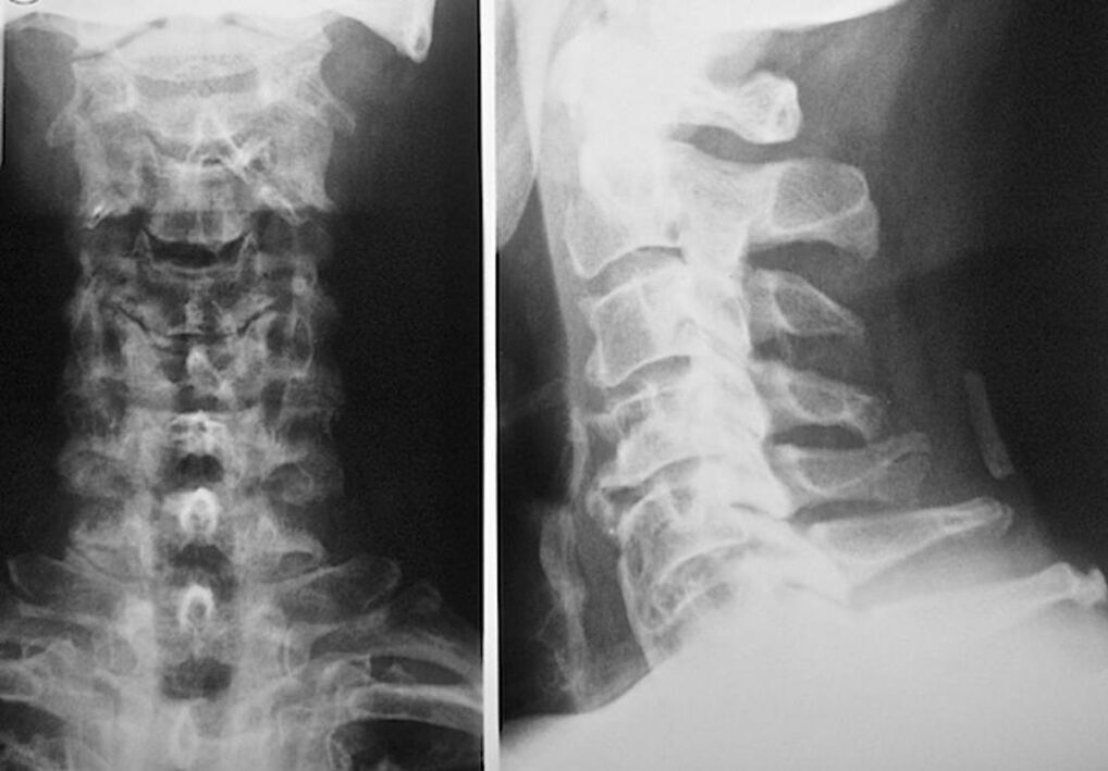 x-ray of the cervical spine with osteochondrosis