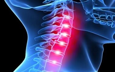 Symptoms of osteochondrosis of the cervical back