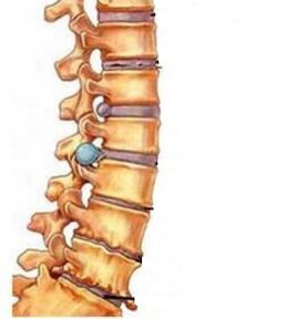 How the cervical region develops osteochondrosis