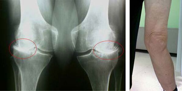 x-ray knee osteoarthritis