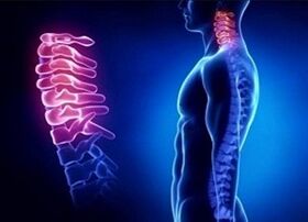 Reasons for the development of cervical osteochondrosis